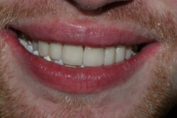 Smile Transformation After 4