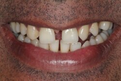 Smile Transformation Before 1