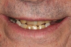 Smile Transformation Before 2