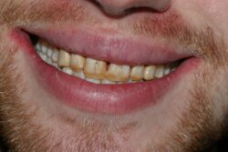 Smile Transformation Before 4