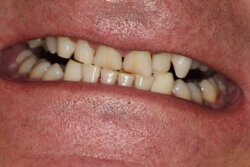 Smile Transformation Before 5