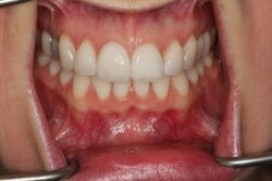 Tooth whitening After 3