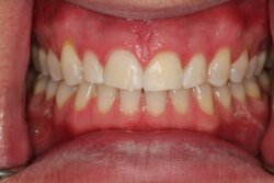 Tooth whitening After 5