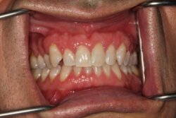 Tooth whitening After 6