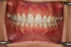 Tooth whitening After 7