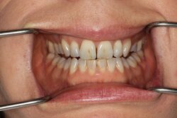Tooth whitening Before 1