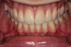 Tooth whitening Before 2