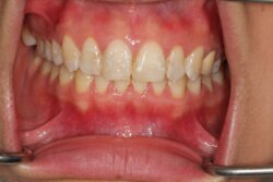 Tooth whitening Before 7